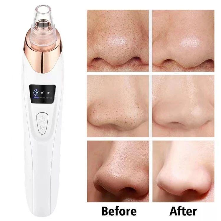 Upgraded Blackhead Remover Vacuum Facial Pore Cleaner Electric Acne Comedone Whitehead Extractor Tool 5 Probes For Women And Men